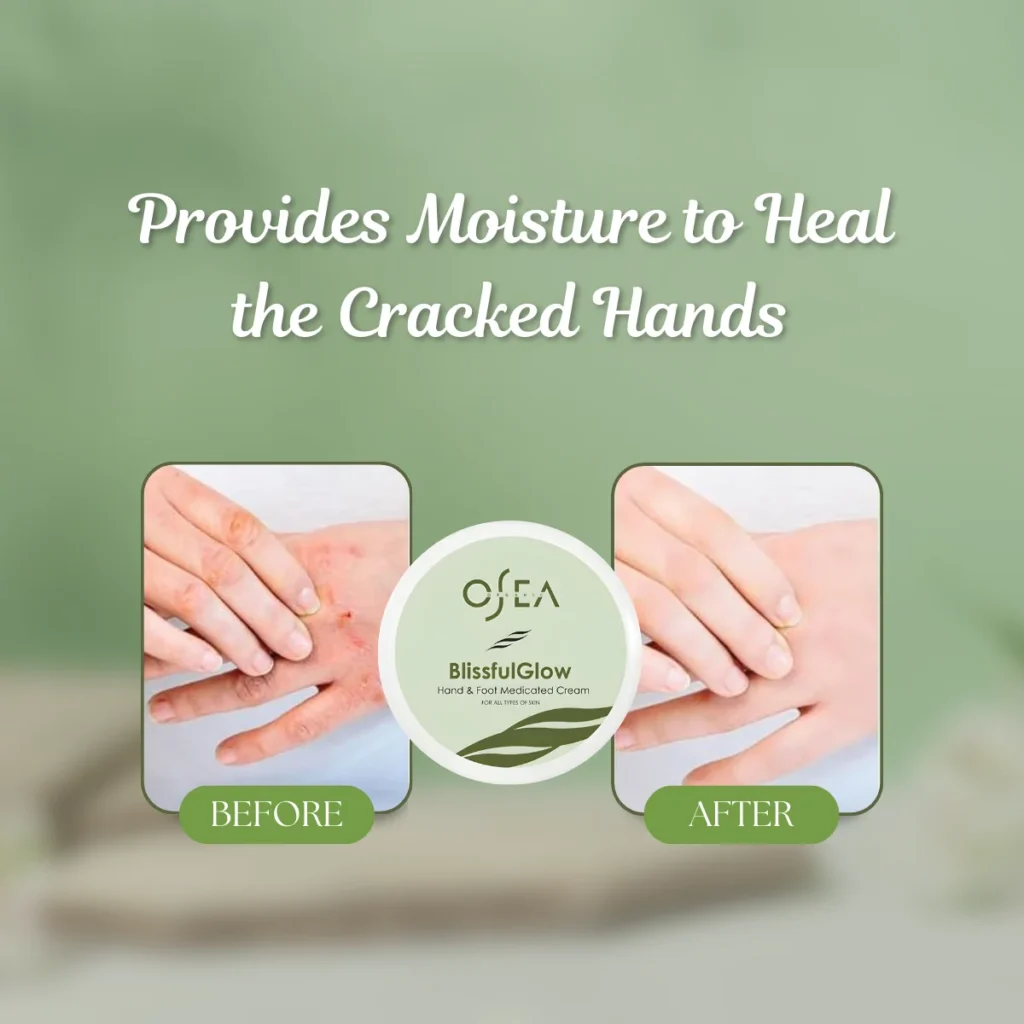 Cracked hands
